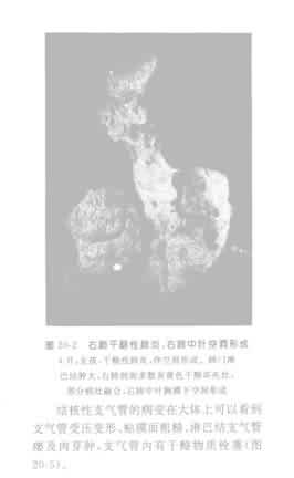 小儿结核病